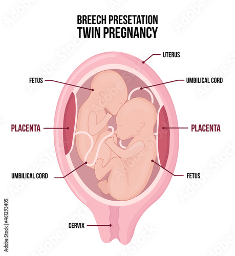 Anatomy of abdomen with twins. Pregnancy women diagrams with breech presentation for both children.