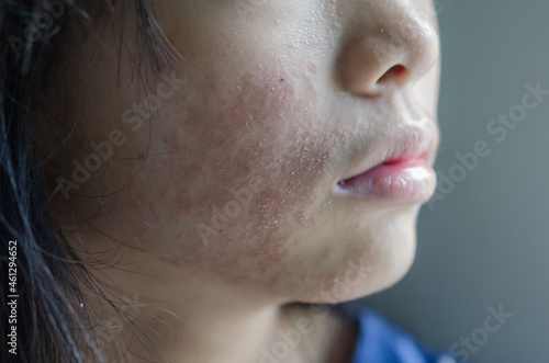 rash face woman allergic to cosmetics food allergy or air allergy