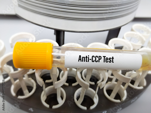 Blood sample for Anti-CCP test, diagnosis for rheumatoid arthritis disease. Cyclic citrullinated peptides test photo