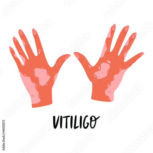 Flat vector cartoon illustration of hands with vitiligo. World vitiligo day. Skin diseases, pigmentation disorders. Isolated design on a white background.
