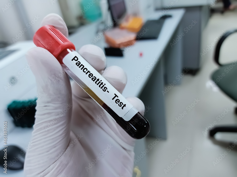 Biochemist or doctor holds blood sample for pancreatitis test, amylase, lipase. Medical test tube in laboratory background. Biochemist or doctor holds blood sample for pancreatitis test, amylase, lipase. Medical test tube in laboratory background.