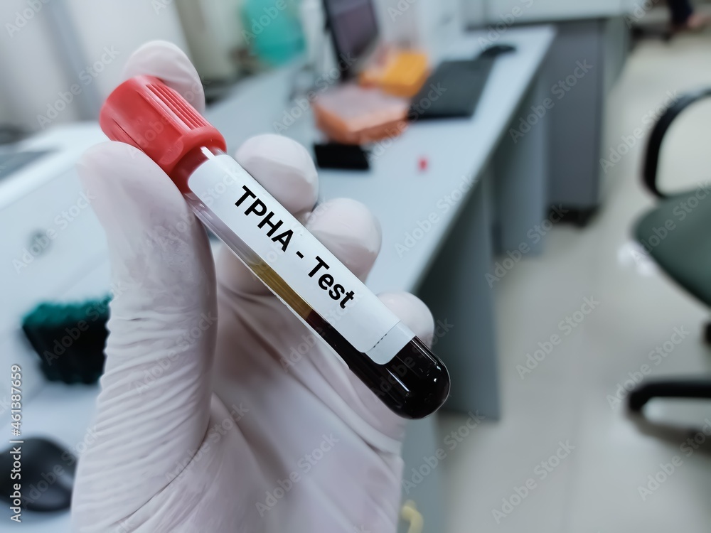 Biochemist or doctor holds blood sample for Treponema pallidum haemagglutination (TPHA) test, Syphilis disease diagnosis. Medical test tube in laboratory background.