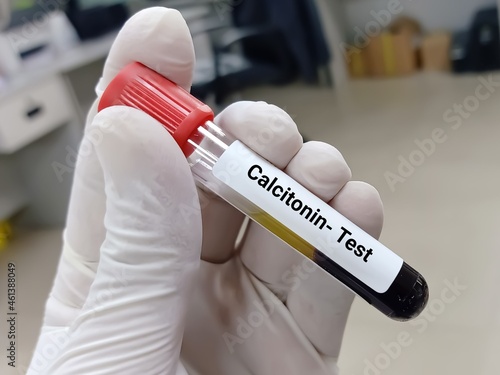 Biochemist or doctor holds blood sample for calcitonin hormone test. It acts to reduce blood calcium, opposing the effects of parathyroid hormone (PTH). Medical test tube in laboratory background. photo