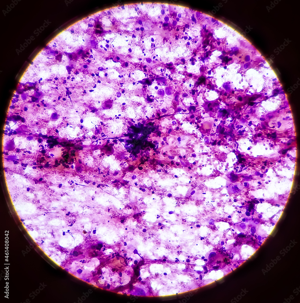 Microscopic view of Metastatic squamous cell carcinoma, atypical ...