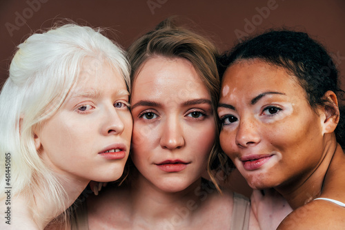 Group of multiethnic women with different kind of skin posing together in studio. Concept about body positivity and self acceptance photo
