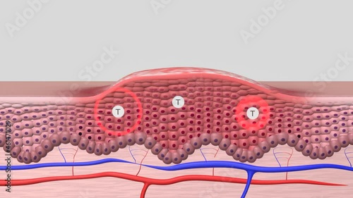 Animation der Schuppenflechte/Psoriasis