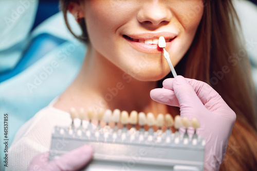 Young woman with teeth color samples. Matching the shades of the implants using shade guide. Preparation for teeth whitening in dental office.