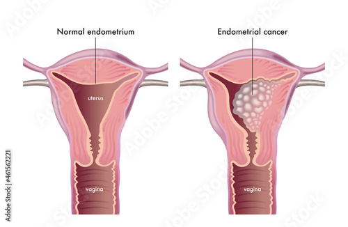 Medical illustration shows a female genital system with a normal endometrium compared with one afflicted of endometrial cancer.