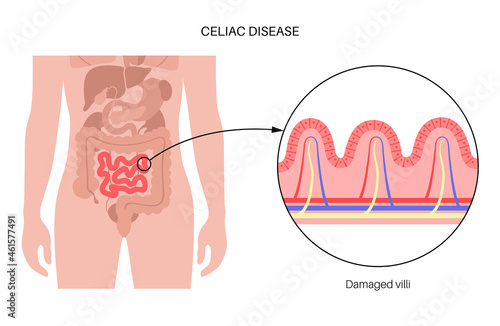 Celiac disease inflammation