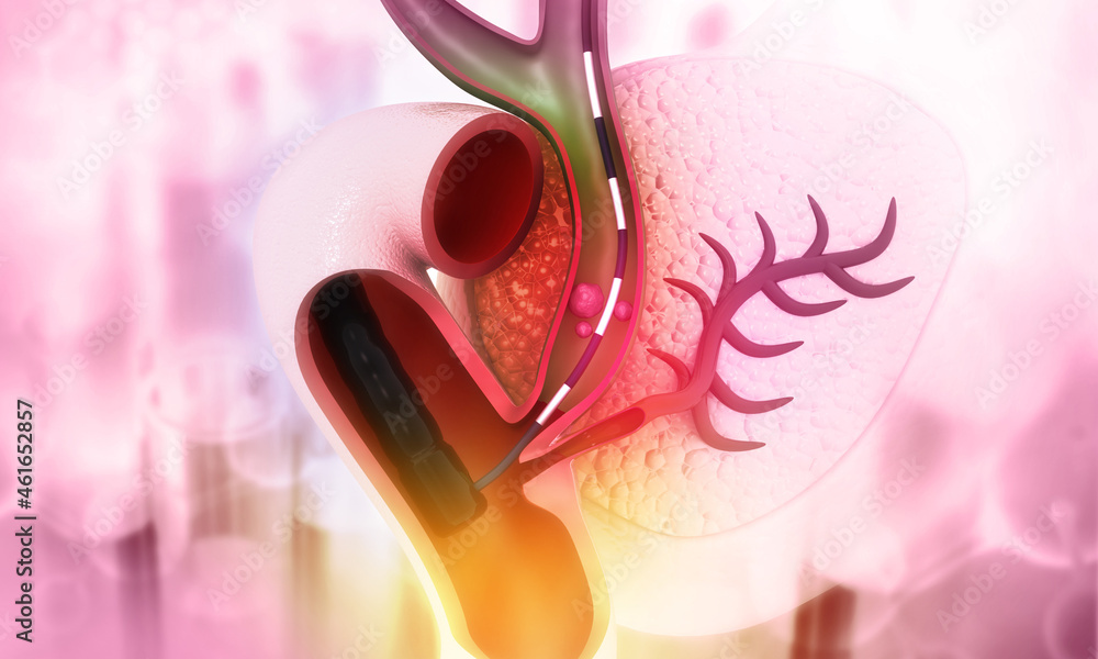Endoscopic removal of gallstones from the gallbladder ducts. Pancreas