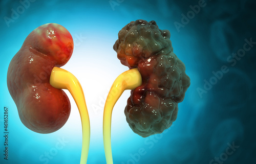 Human polycystic kidney disease. 3d illustration photo
