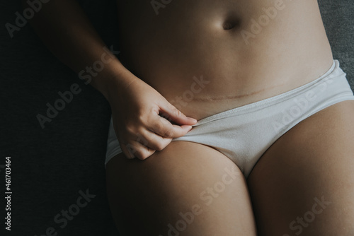 Young woman in white panties, caesarean section scar.