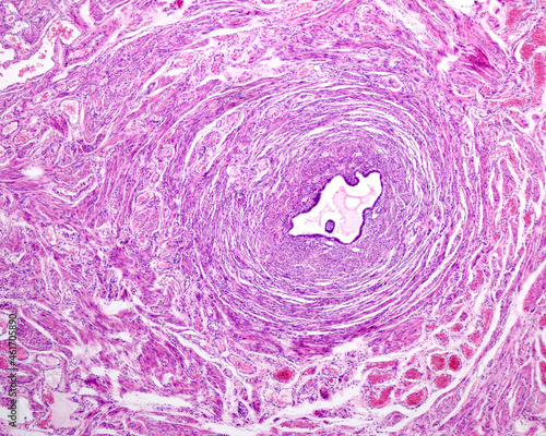 Intramural uterine tube photo