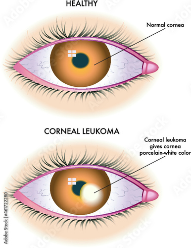 Medical illustration shows the comparison between a normal eye and one affected by corneal leucoma.
