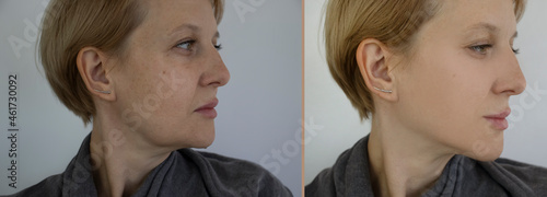 Obraz na plátně woman face wrinkles before and after treatment