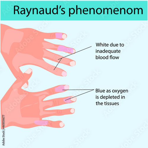 Reynaud's phenomenon sign stock illustration.