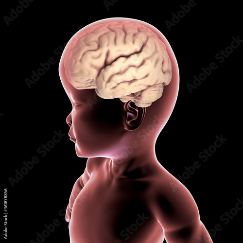 A child with macrocephaly and enlarged brain photo