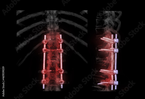 lumbar spine AP and Lateral view  for diagnosis spinal canal stenosis and degenerative disc disease showing pedicle screw implant after surgical decompression and spinal fusion. photo