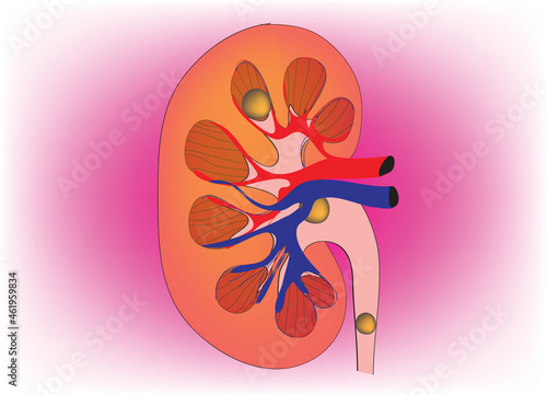 Biological illustration of kidney stones 