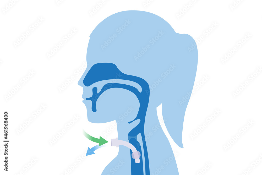 Surgical to inserted a siliconized tube into the Woman's neck and trachea to help breathe. Illustration about Medical to help a patient who can not breathe with nose and mouth. Surgical to inserted a siliconized tube into the Woman's neck and trachea to help breathe. Illustration about Medical to help a patient who can not breathe with nose and mouth.