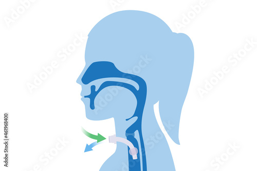 Surgical to inserted a siliconized tube into the Woman's neck and trachea to help breathe. Illustration about Medical to help a patient who can not breathe with nose and mouth.