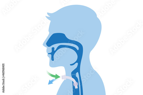 Surgical to inserted a siliconized tube into the men's neck and trachea to help breath. Illustration about Medical to help a patient who can not breathe with nose and mouth.