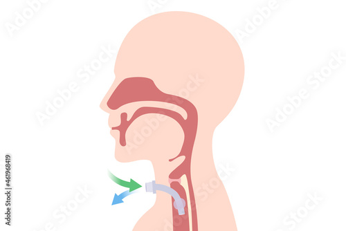 Tracheostomy at the human neck for inserted a siliconized tube into the trachea to help breathe. Illustration about surgical to help a patient who can not breathe with nose and mouth with a tube. photo