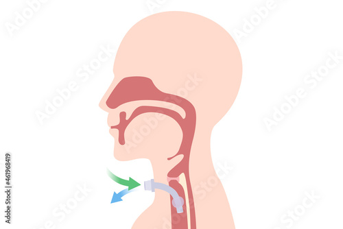 Tracheostomy at the human neck for inserted a siliconized tube into the trachea to help breathe. Illustration about surgical to help a patient who can not breathe with nose and mouth with a tube.