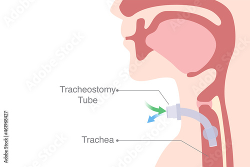 Tracheostomy is an opening created at the front of the neck for inserted a siliconized tube into the trachea to help breathe.