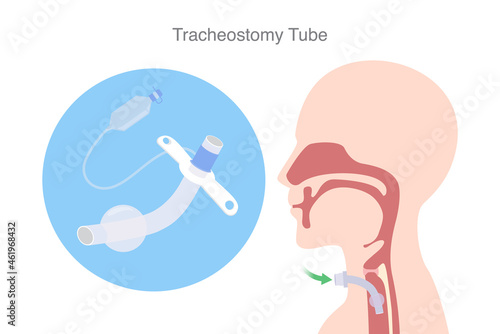 Tracheostomy tube is a device to help a patient who can not breathe with nose and mouth. Illustration about Tracheostomy is surgical to inserted a siliconized tube into the trachea to help breath. photo