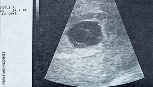 Fotografiet Ultrasound image of the gestational sac and the vitelline bladder with the embry
