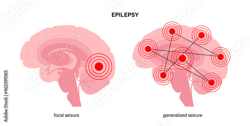 epilepsy seizure concept photo