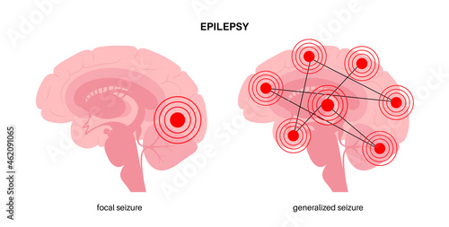 epilepsy seizure concept