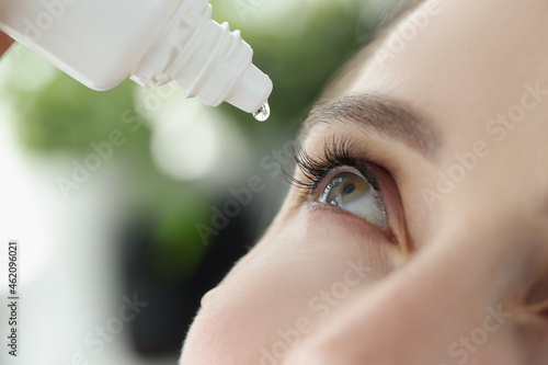 Foto Woman drips eye drops into eye for allergies closeup