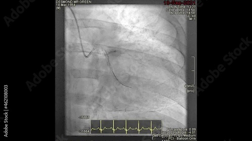 Coronary Angioplasty Stent Insertion Procedure photo