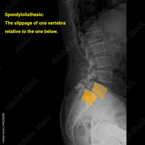 x ray image of  spondylolisthesis vertebral x ray
