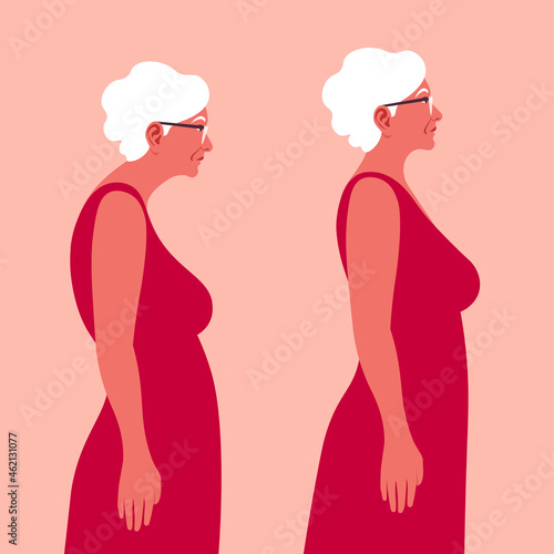 An Elderly woman with a bad posture. Spine. Profile. Kyphosis. Flat vector illustration on red background. Minimalism