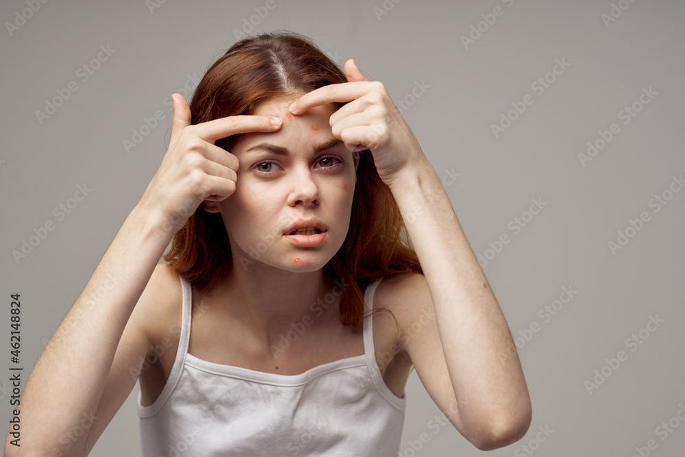 beautiful woman in a white t-shirt pimples on the face light background beautiful woman in a white t-shirt pimples on the face light background