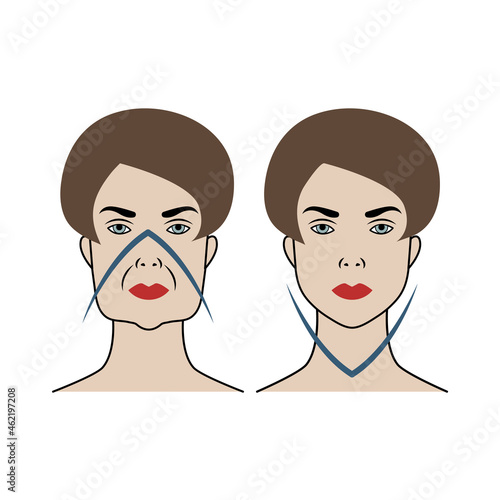 Lifting of female face. Comparison before and after