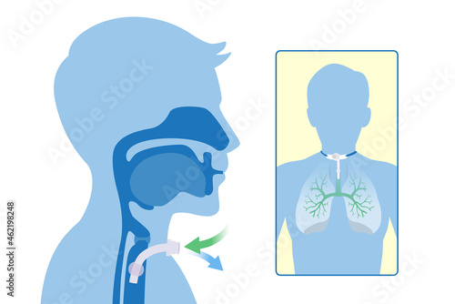 Insert the siliconized tube into the trachea to help breathe. Illustration about Anatomy of Tracheostomy is surgical at the neck and airway to help a patient.