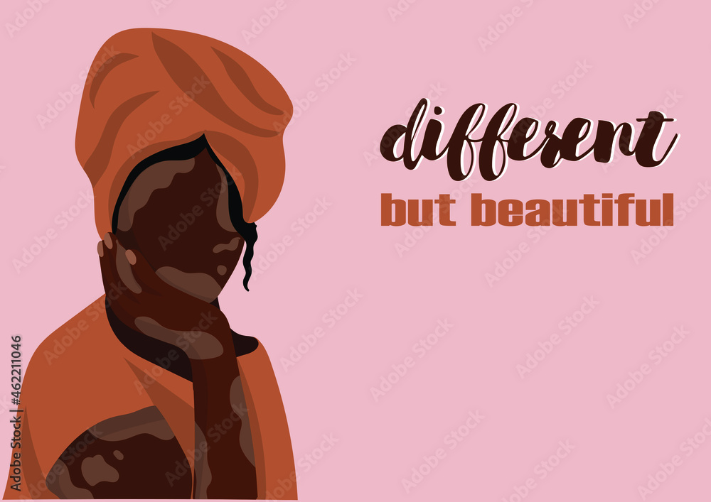 A young girl with Vitiligo skin problems. Body positive concept. World vitiligo day. Vector illustration A young girl with Vitiligo skin problems. Body positive concept. World vitiligo day. Vector illustration