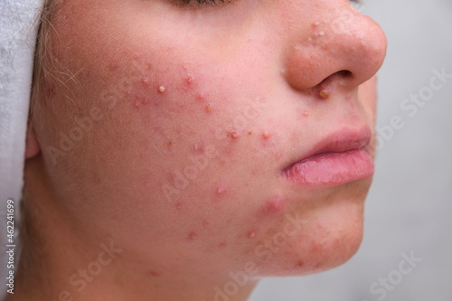 Acne. Teenage girl with the pimples on her face. Problematic skin. Close-up. photo