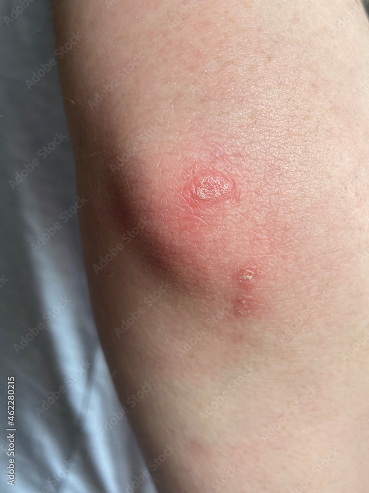 Psoriasis skin condition that causes red, flaky, crusty patches of skin