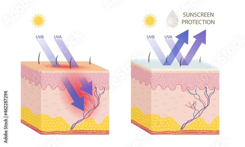 Human skin with and without sunscreen protection on white background.