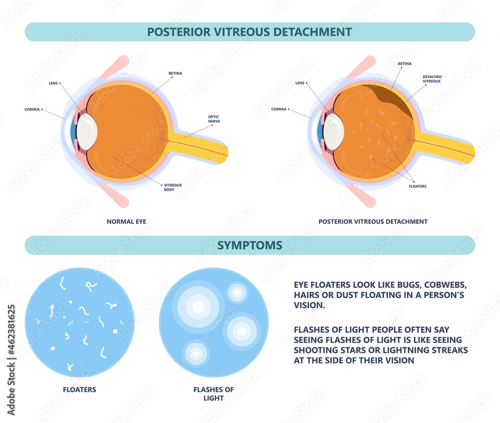 Eye floaters fluid vision retina myopia trauma surgery loss of light