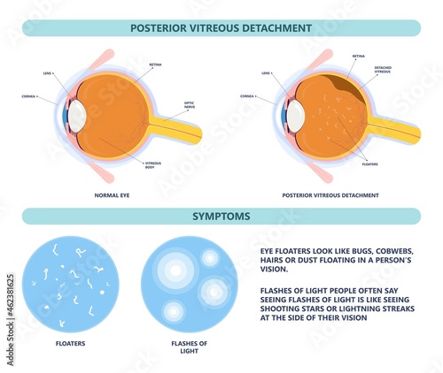 Eye floaters fluid vision retina myopia trauma surgery loss of light tear torn laser surgical repair older Detached blurry shadow Pain injury hole macular Age treat blood dark lose wear Pars Plana