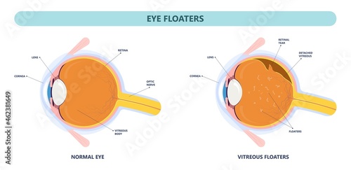 Eye floaters fluid vision retina myopia trauma surgery loss of light tear torn laser surgical repair older Detached blurry shadow Pain injury hole macular Age treat blood dark lose wear Pars Plana