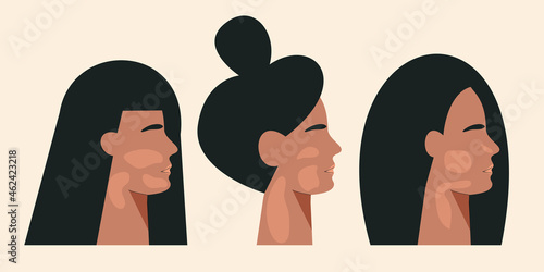 Women silhouette with vitiligo chronic skin pigmentation disorder. World vitiligo day concept. Portrait of girl with skin disease. Different Beauty. Flat vector illustration isolated white background