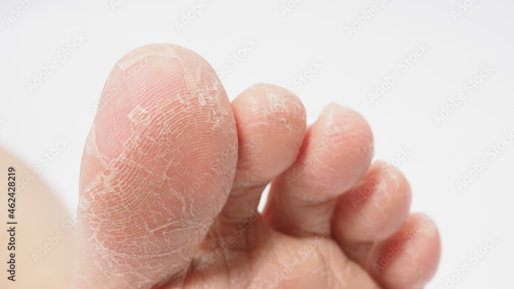 Foot peeling or remove dead skin on white background. Foot peeling or remove dead skin on white background.