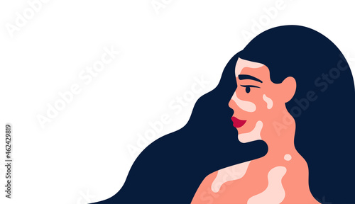 Beautiful female with vitiligo pigment skin and has a lot of blue hair vector illustration